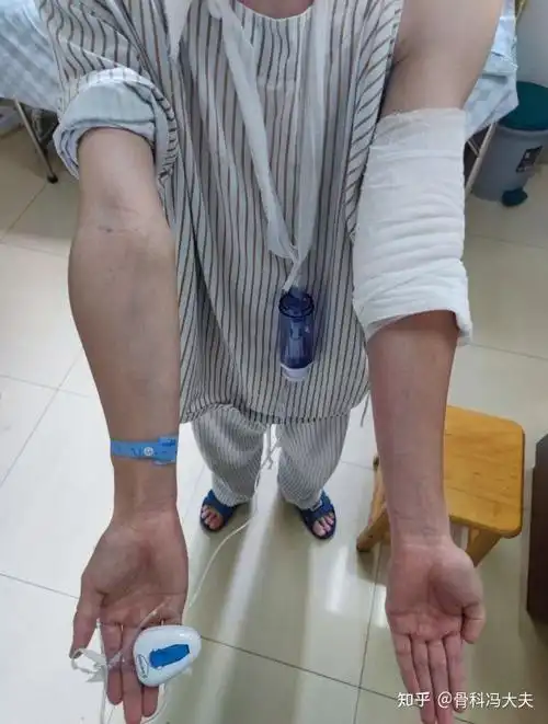 手臂畸形肘关节内翻畸形手术矫形后恢复正常外观