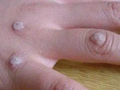 手上长鱼鳞痣怎么办_寻常疣_北京京城皮肤病医院(北京医保定点机构)