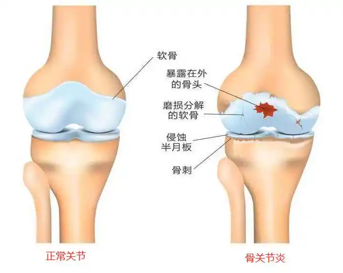 关节疼痛是怎么回事怎样缓解(膝关节疼痛是怎么回事?