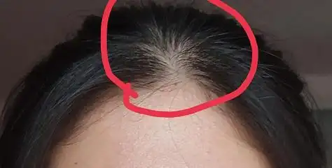 【前额发际线有漩涡的人好吗女】单身女人女人发际线有旋,单身女人有