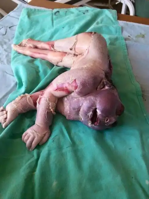 无脑婴儿又再诞生人间悲剧