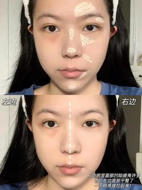 改善面中凹陷年轻十岁面部扁平有救了