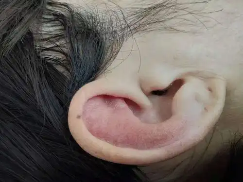 耳朵突然肿了身体没有感觉任何不适谁有过这样情况吗