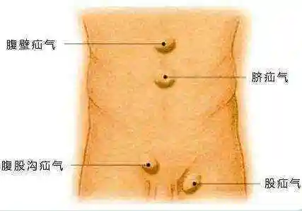 按照疝的发生部位可分为脐疝,股疝,腹股沟疝.