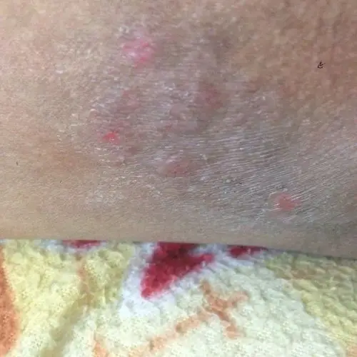 大腿内侧好痒,还会出水,这是怎么了.