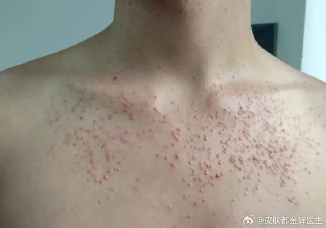 毛囊炎##健闻登顶计划