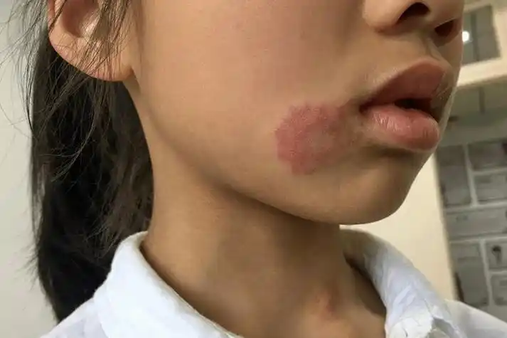 脸上干燥起皮有癣图片