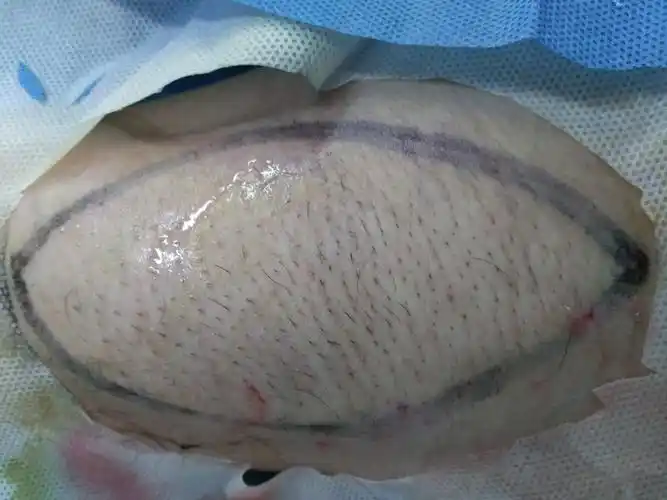 切除范围手术切口术后7天拆线一般患者术后两三个月,切口平整,根本看