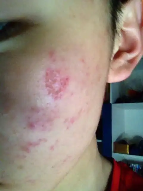 用脱毛膏的时候脸部灼伤了 现在脸上结痂了 请问多久能好?