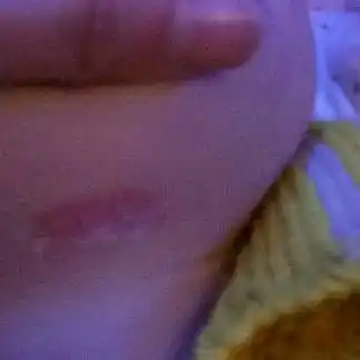 宝宝下巴长了一个红包,还有一点脱皮长水泡的感觉,是什麼东西,什麼