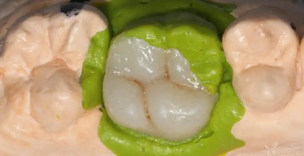 【经验交流】在路上——树脂嵌体. [病例帖]