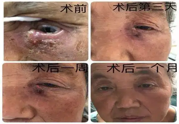 不损伤内眦韧带及眦静脉等组织4,手术适应各种急,慢性性泪囊炎,鼻泪管