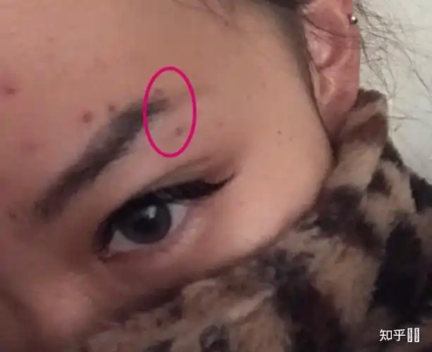 眉钉带时间长摘下会长住吗