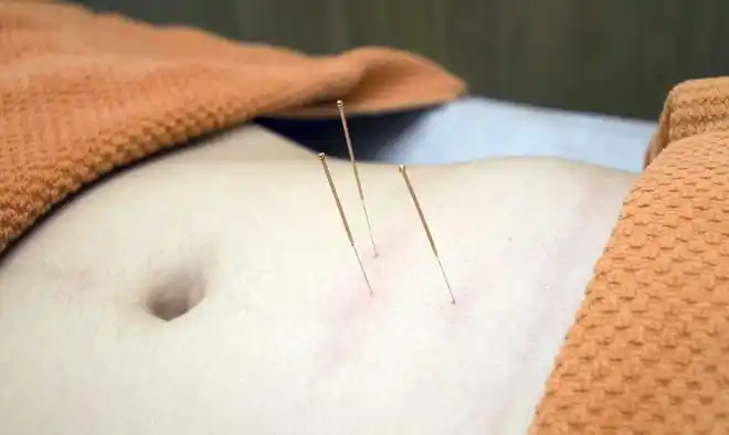 不孕症与心理因素,教你如何中医选方配合针灸治疗