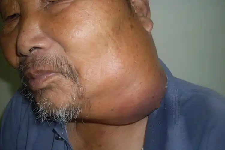 颈部巨大肿块 - 肿瘤医学专业讨论版 - 爱爱医医学论坛