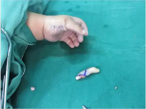 小孩多指切除案例_多指畸形_手术_治疗方法_治疗方式 - 好大夫在线