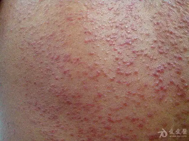 罕见的全身多发性皮疹3年