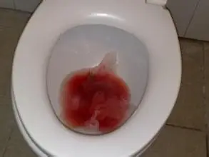 最常见的便血是由肛肠疾病引起的,血色鲜红,如痔疮,直肠息肉等