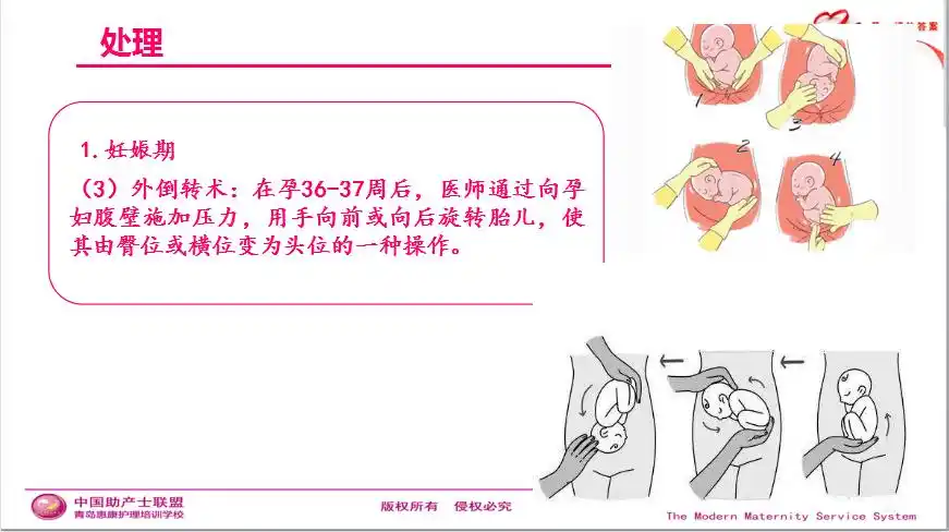 每周一课臀位自然分娩知识解读与技巧