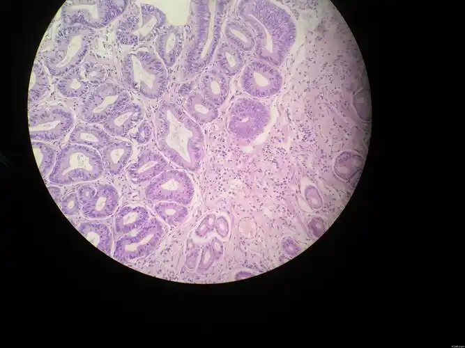 胃窦部充血糜烂 考虑肠型高级别讨论病例【山东省消化道早癌病理群】