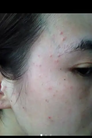 我脸上湿疹20多天了 涂了几种药膏 吃药 现在在喝中药 感觉脸上凸起红