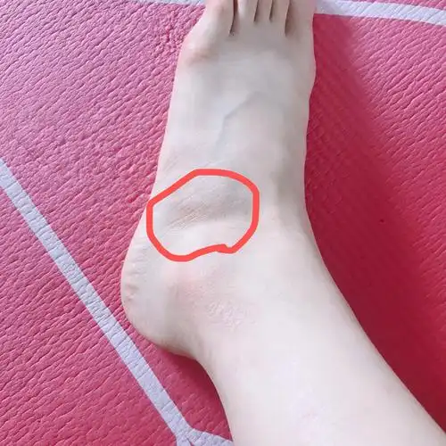 有哪位大神指导一下左脚这个位置跑步就疼怎么治已经休息好一段时间了