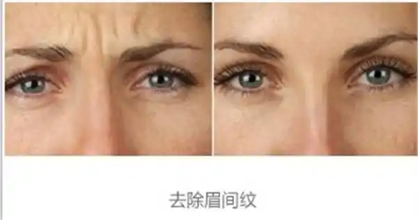 玻尿酸去眉间纹不适合哪种人