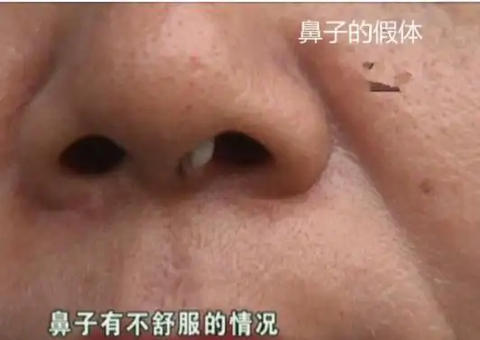女子6年前隆鼻,如今假体露出,院方:不是医院的责任