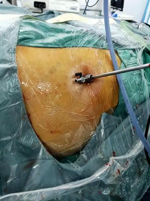 经皮肾镜碎石手术_肾结石 - 好大夫在线