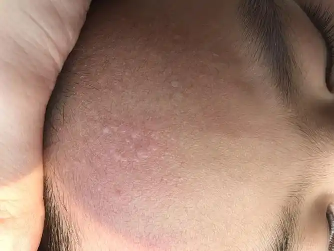 小孩额头上长一个个这样白色的东西,请问有知道是什么皮肤问题吗?