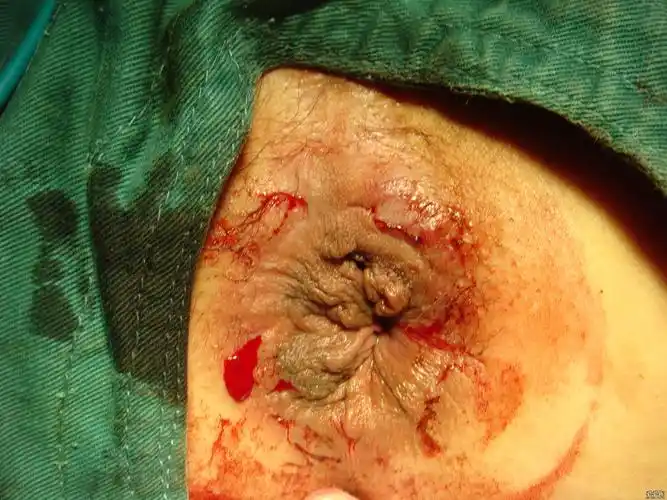 发一个pph图加外痔切除