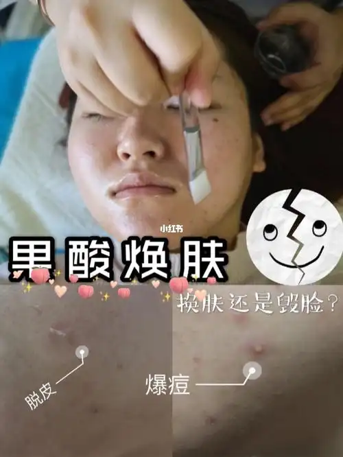 医美科普果酸焕肤是换皮还是毁脸