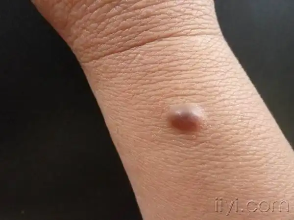 前臂蚕豆大丘疹,伴疼痛(答案:良性纤维组织细胞瘤 - 皮肤及性传播疾病