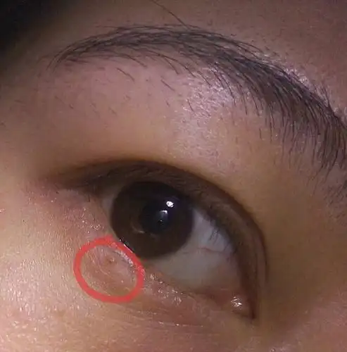 眼睛下面有小肉点一样的颗粒,这是什么?怎么去除?