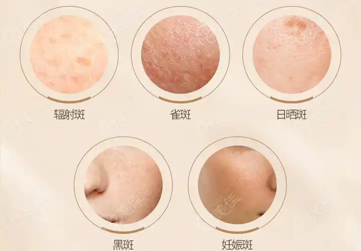 郑州皮秒祛斑哪家医院比较好有名气价格还不贵是这几家