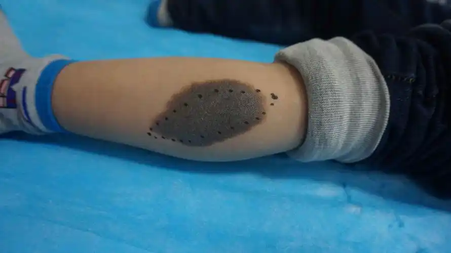 患者解惑:黑毛痣任其发展真的会恶变吗?_痣_痣介绍 - 好大夫在线