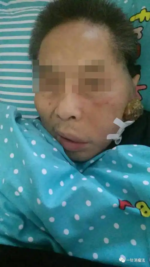 鼻咽癌治疗大块肿瘤通过微创彻底消除绽放生命奇迹