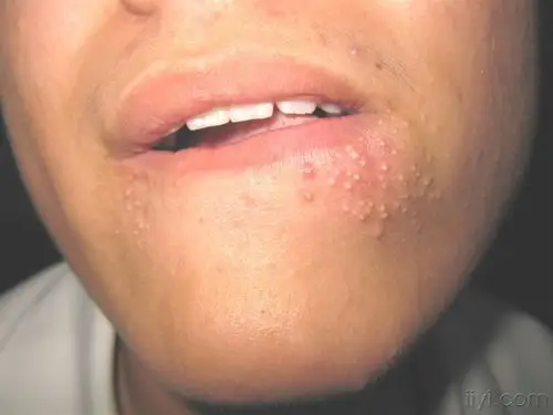 看图识病----------白头粉刺(痤疮) - 皮肤及性传播疾病讨论版 - 爱爱