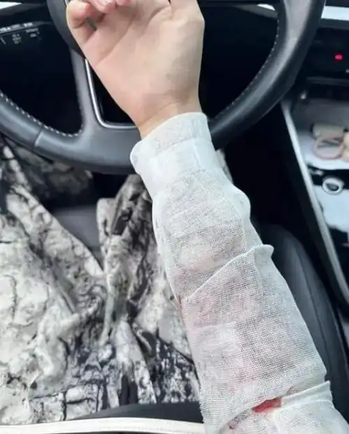 江西女子忍痛洗掉纹身,整个手臂裹着纱布,曾经的时尚变成了负担