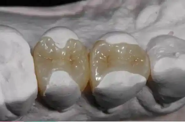 牙齿嵌体可以用几年