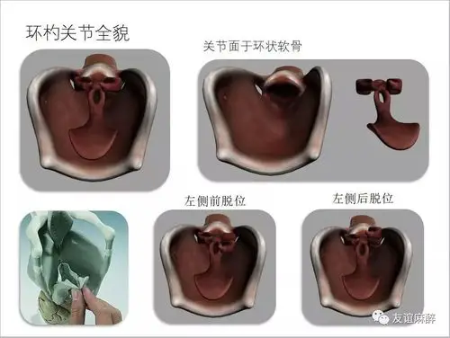 围术期出现环杓关节脱位如何诊断处理