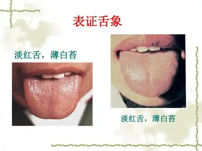 表证舌象 淡红舌,薄白苔 淡红舌,薄白苔
