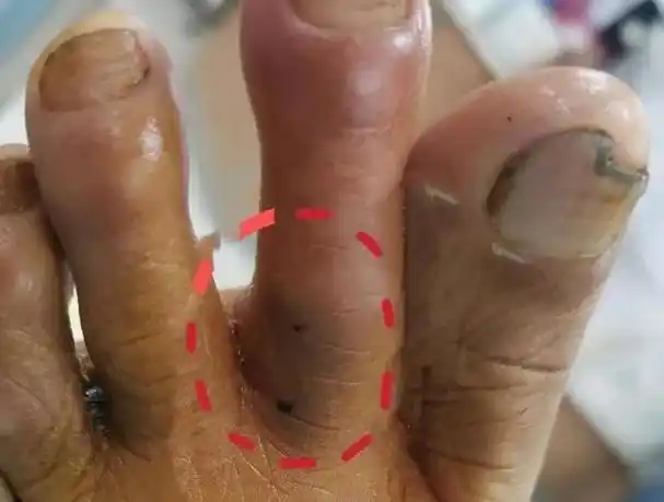 蛇咬后的齿痕对比02五步蛇海蛇蝰蛇金环蛇银环蛇眼镜蛇烙铁头青竹蛇