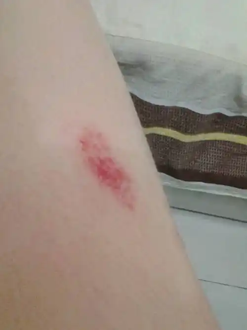 腿擦伤会不会留疤