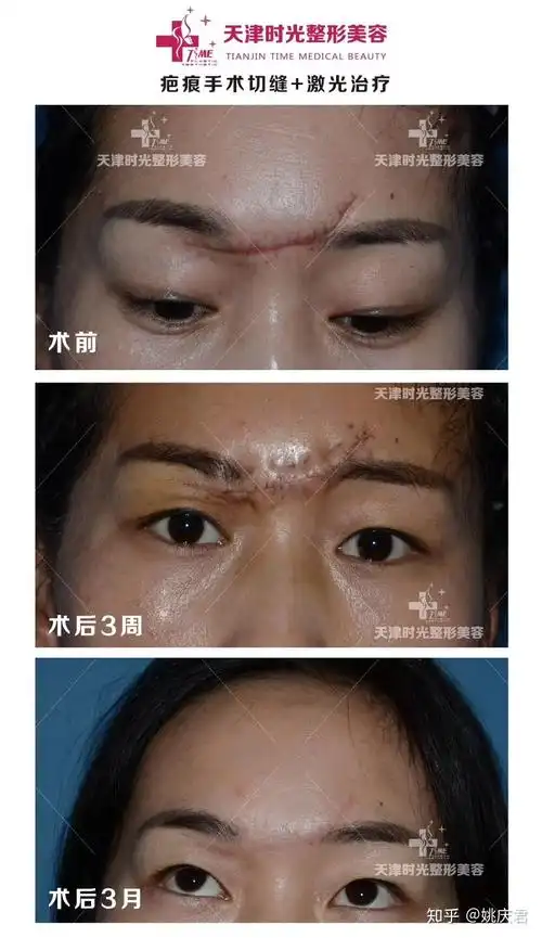 今天的案例是外伤后门诊普外缝合留下的疤痕,通过重新的切除 美容缝合