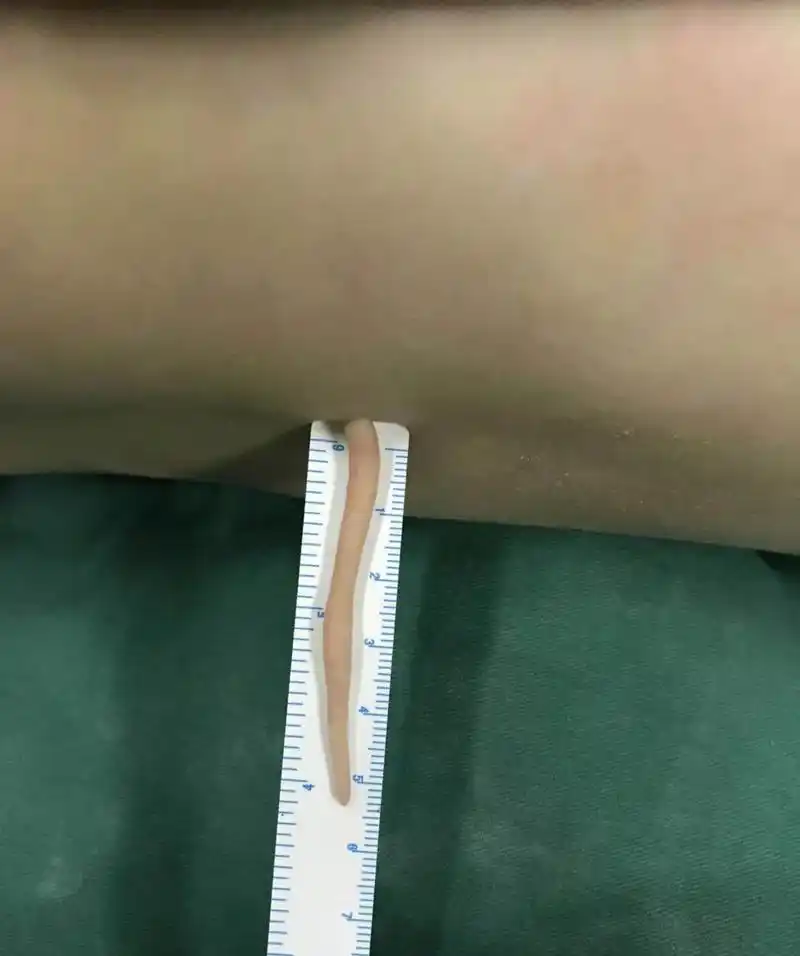 武汉半岁宝宝背上长了一根6厘米长的"尾巴"!罪魁祸首竟是