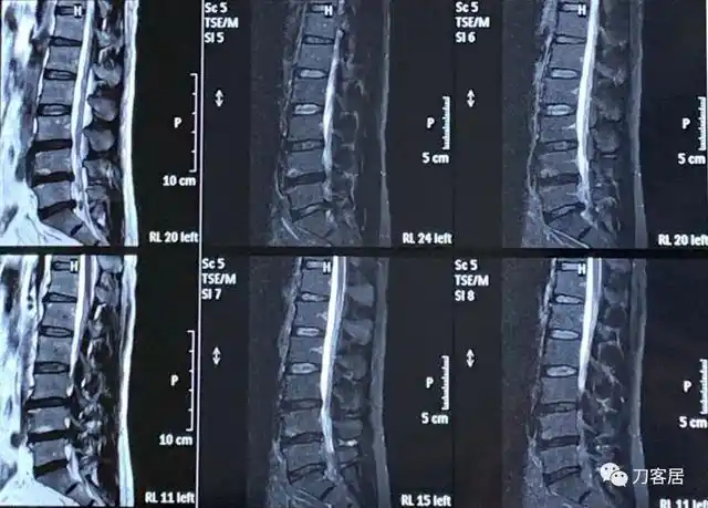 我的门诊病历:腰5骶1椎间盘突出症,保守治疗