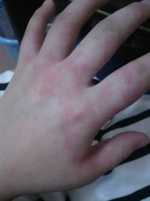 1 分钟前蒋康伦 医师来自南京大学医院 答: 看图最常见考虑湿疹