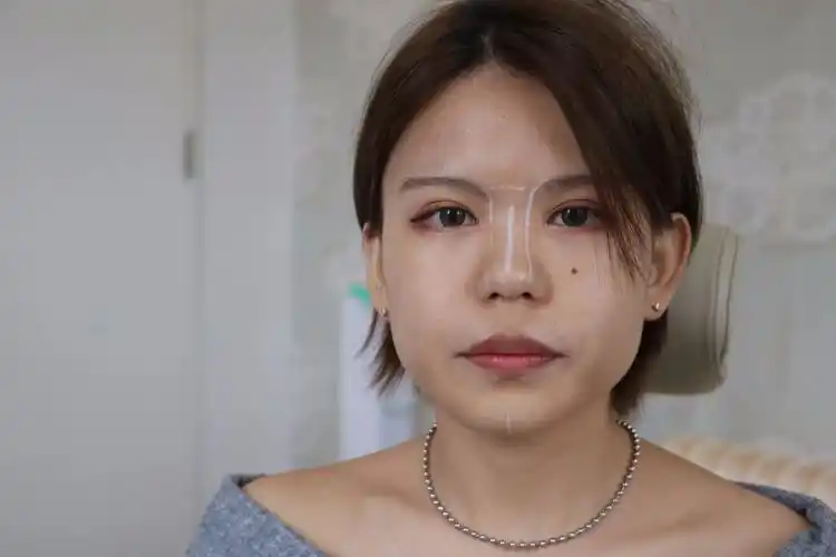 专为"塌鼻子"打造的玻尿酸隆鼻定制计划_洪恺志_主治医师_爱问健康