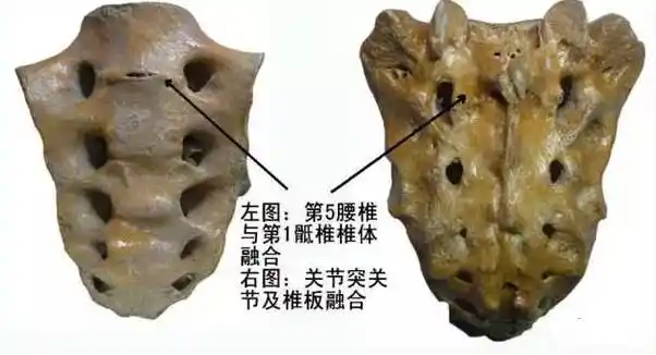 骶骨的重要性